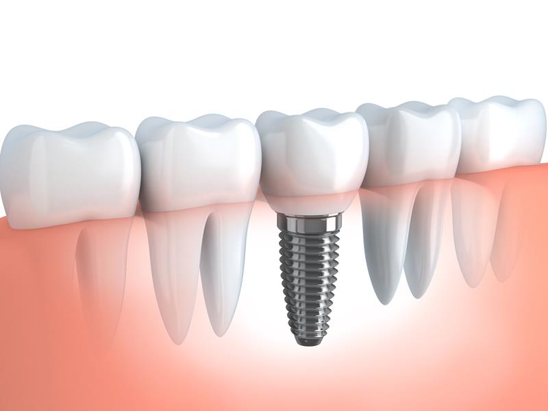 Dental Implants  Redding, CA  - 